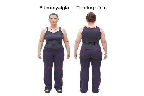 Fibromyalgia